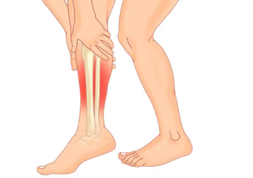 behandeling scheenbeenpijn